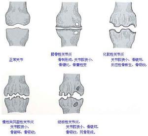 类风湿关节炎症状早期如何表现?