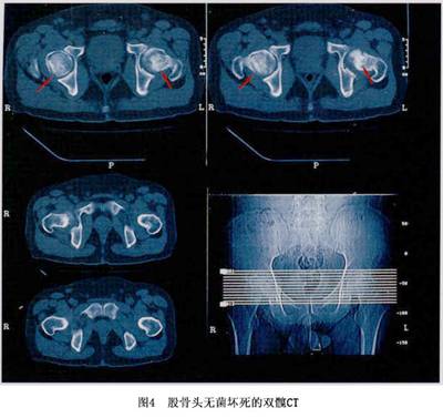 什么是股骨头坏死缺血性坏死?