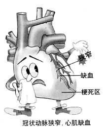 冠心病的病因有哪些