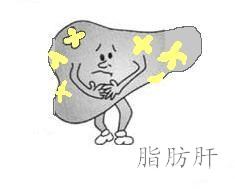 你了解重度脂肪肝的临床表现吗?