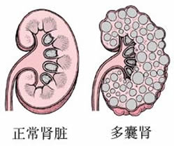 多囊肾常见分型都有哪些?