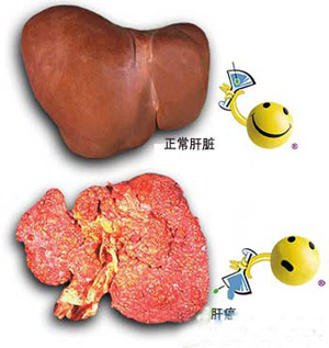 肝癌晚期患者临死前的症状