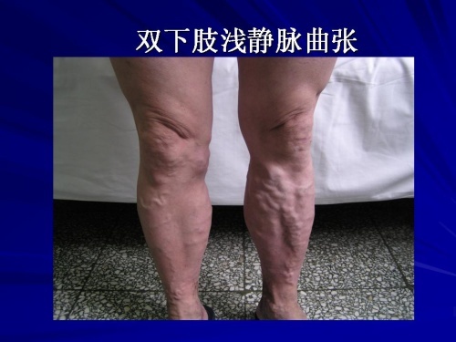 下肢静脉血栓治疗方法